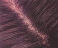 Псориаз волосистой части головы после лечения